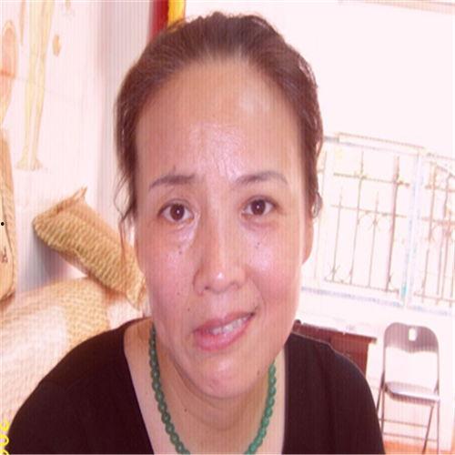 面瘫照片,从照片看面部神经受损的蛛丝马迹