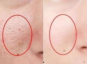 毛孔粗图片,图片解析与改善策略